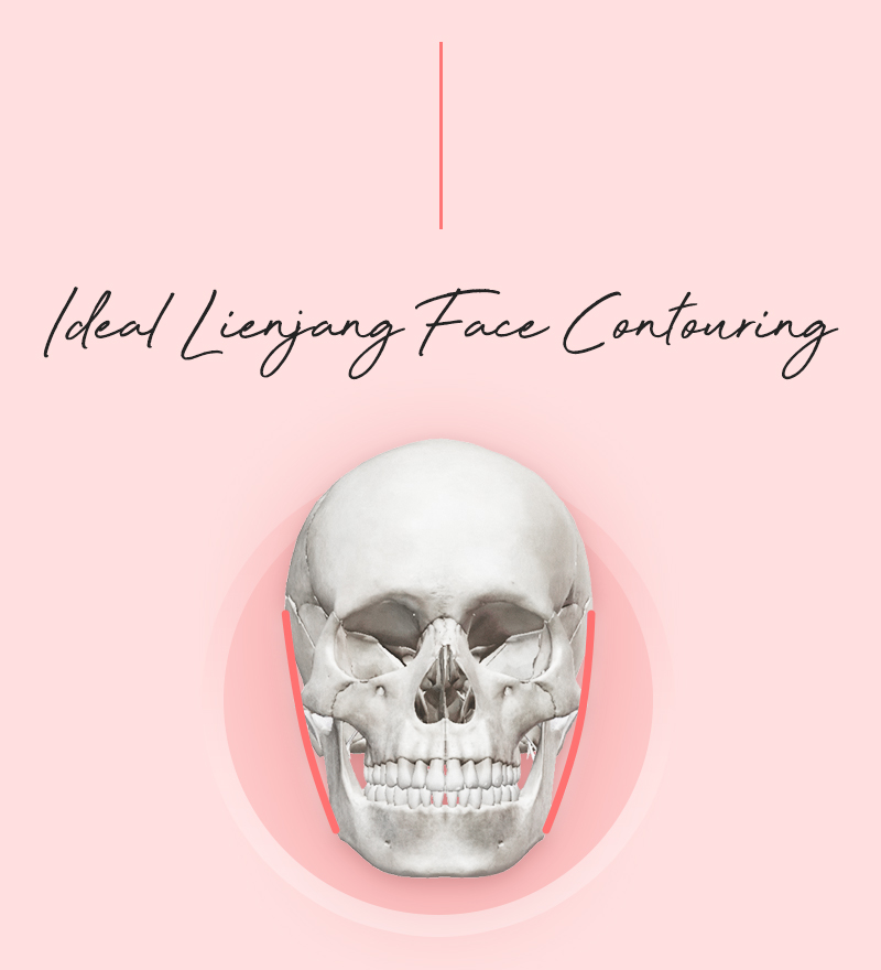Before and after results of cheekbone reduction at Lienjang, offering a sculpted, elegant facial contour with precision and care