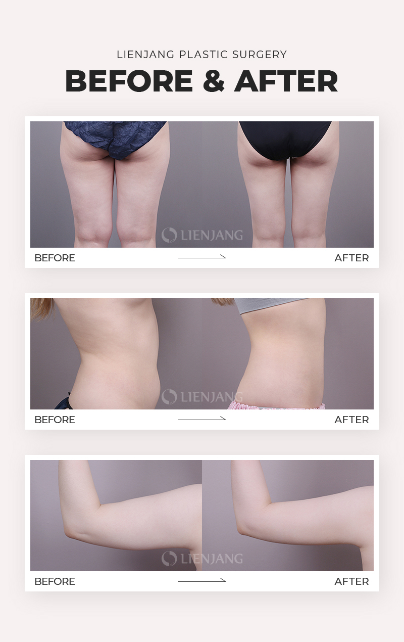 Before and after body liposuction at Lienjang, achieving a slimmer, more contoured figure with precise fat removal.