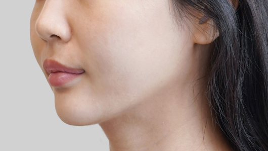 ONDA Lifting technology tightening and rejuvenating skin for a refreshed appearance