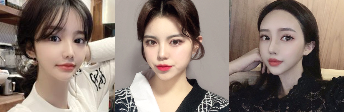 Before and after results of "Full 5D face fat grafting at Lienjang